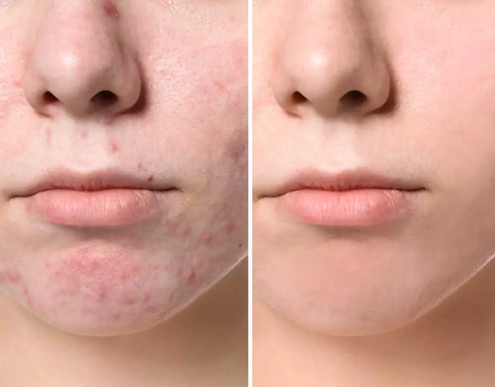Healing acne-prone skin